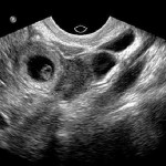 внематочная беременность ( по УЗИ)
