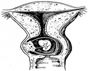 Шеечная беременность