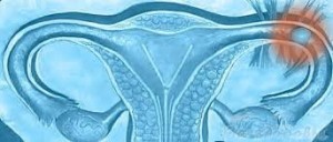 Разрыв фаллопиевой трубы при внематочной беременности