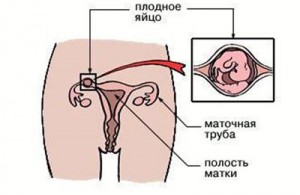 Эктопическая (внематочная) беременность