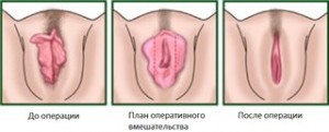 Пластика половых губ. Техника проведения