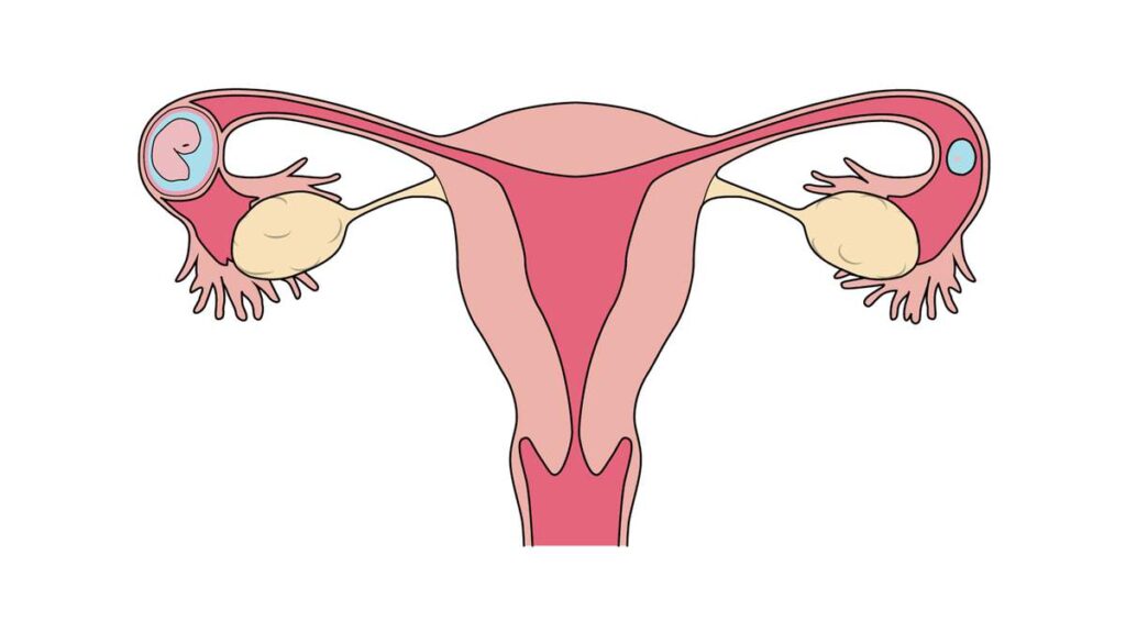 Внематочная беременность- схематическое изображение