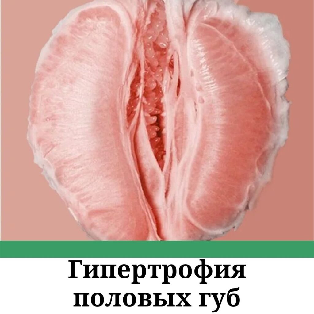 Гипертрофия половых губ